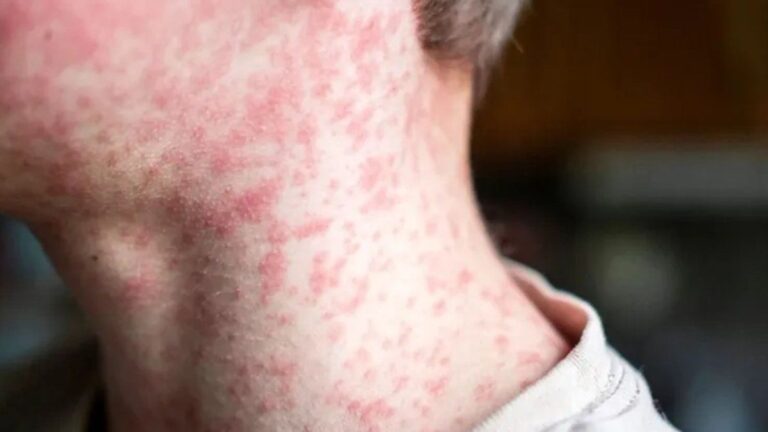 Confirman en la Ciudad el primer caso de sarampión en Argentina en 2026